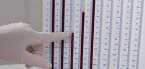 تحليل سرعة ترسيب الدم
